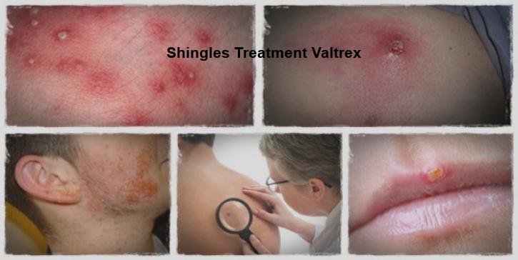 valacyclovir treat shingles